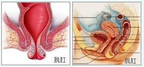 两个肉球脱出是什么痔疮,掉出肉球是痔疮吗