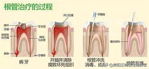 看牙是个漫长痛苦的过程,你以为的看牙费用vs实际看牙费用