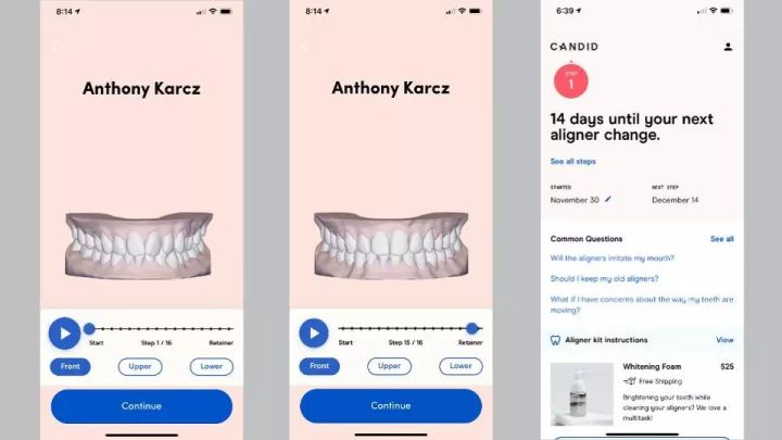 3d打印牙套工艺流程,3d打印牙齿和牙套哪个效果好