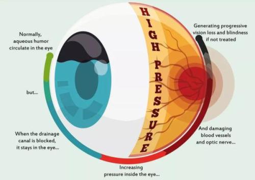 COVID-19疫情期：青光眼患者的自我防护