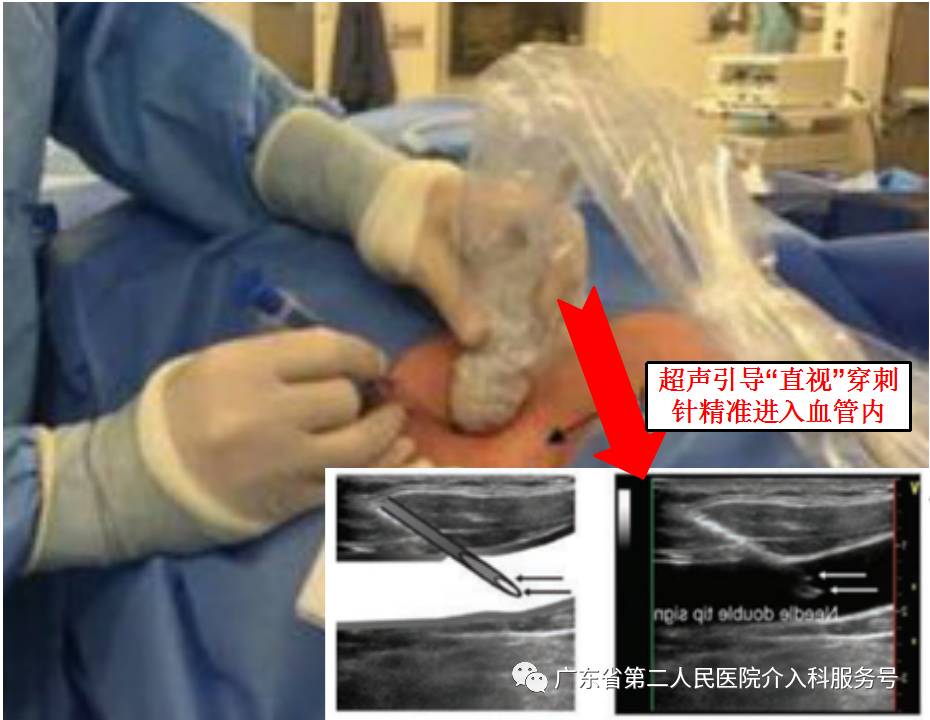 输液港能多次做吗,输液港可以重复使用吗