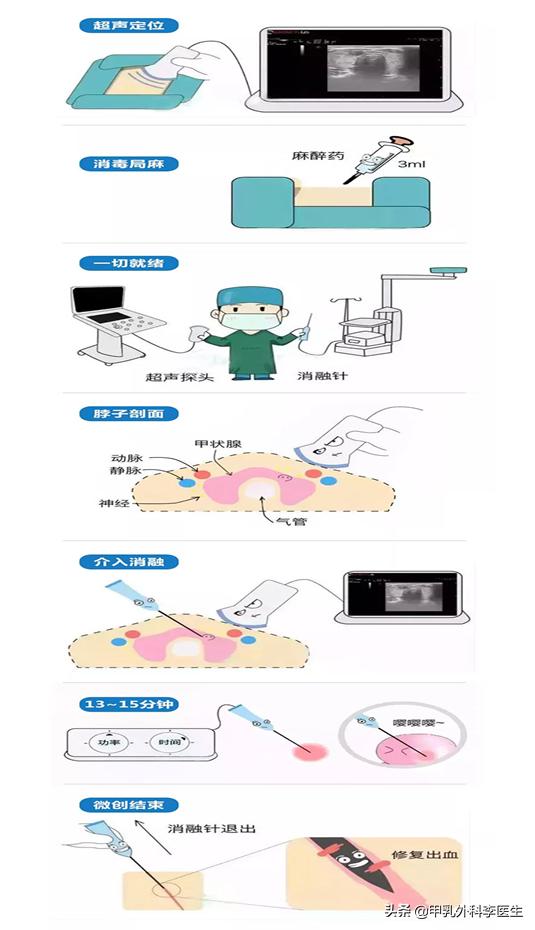 消融术治疗甲状腺结节要多久能好,甲状腺开刀还是消融术