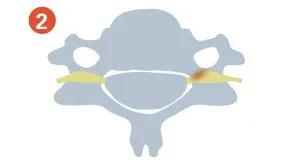 颈椎生理曲度变直有骨刺怎么办,颈椎x线片能看到什么吗