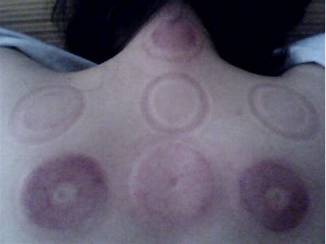 拔罐需要注意什么事项,肚子拔罐方法及注意事项