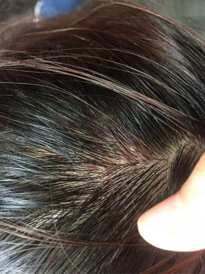 头皮屑多怎么办9个方法告别头屑,头皮屑多怎么办快速消除用什么药