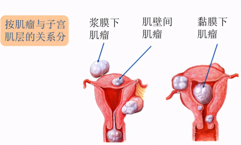 体检突然发现子宫肌瘤,发现子宫肌瘤怎么办