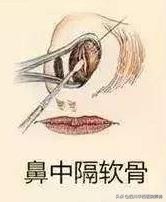 膨体鼻中隔耳软骨隆鼻后遗症,隆鼻后鼻中隔软骨突出怎么办