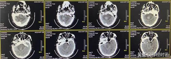 高血压小脑出血治愈率多大,高血压导致小脑出血