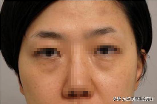 做眼袋手术的费用，听说中年人比年轻人要偏贵？有了解的谈一谈