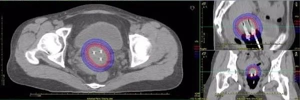 什么是近距离交叉口,什么是近距离用眼时间