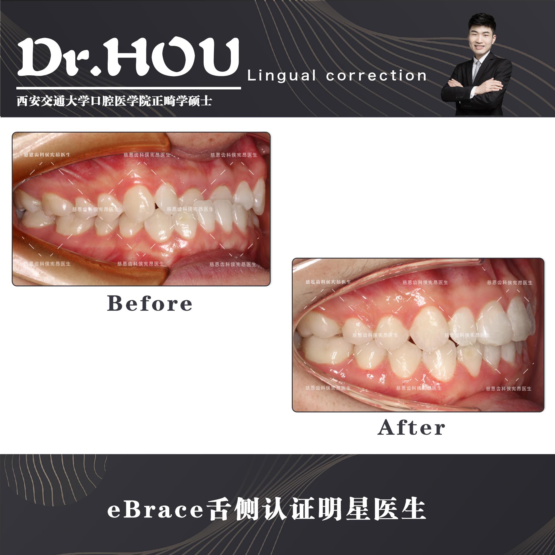 地包天的牙齿图片,牙齿地包天怎么补救