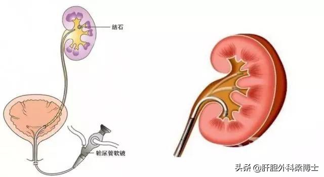 体外碎石肉眼看不见的石头,体外碎石的适应症有哪些