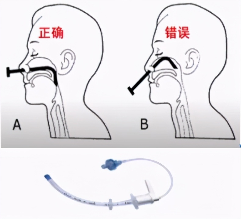 无痛纤支镜检查麻醉注意事项,超声内镜检查要不要麻醉