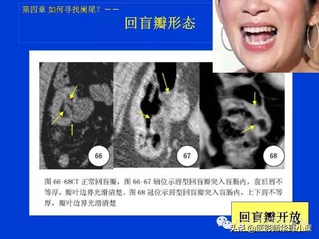 阑尾炎课件,阑尾炎的超声课件