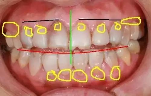 烤瓷牙套里的牙烂了有什么症状,烤瓷牙牙套里的牙烂了怎么处理
