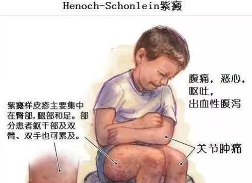 血液过敏性紫癜容易治疗么,妊娠合并血小板减少性紫癜表现