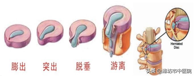 针灸治疗腰椎间盘突出几次有效果,针灸女性腰椎间盘突出视频观看