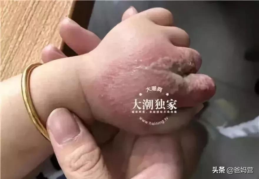 妈妈一拍小孩差点毁容,妈妈拍到孩子的恐怖画面