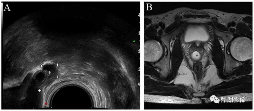苗勒氏管囊肿在哪里,苗勒氏管囊肿是指什么