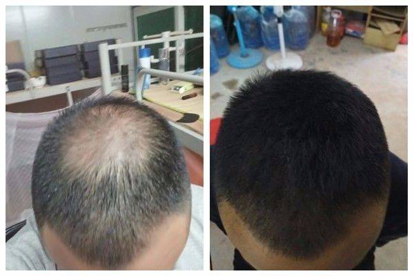 脂溢性脱发案例,脂溢性脱发生发视频