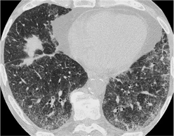 间质性肺疾病看病经验分享,分享肺腺癌临床实验的例子
