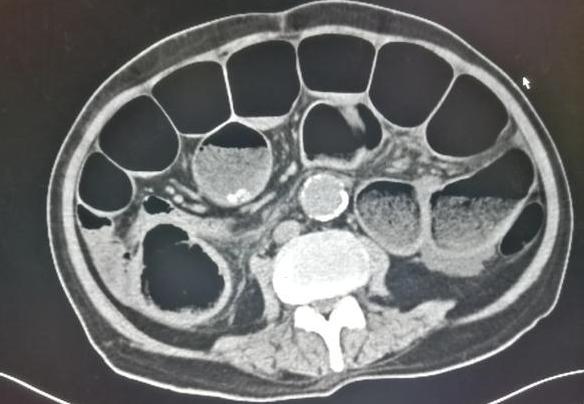肚子老是咕噜咕噜响是肠癌表现吗,肚子咕噜咕噜响胀气是怎么回事