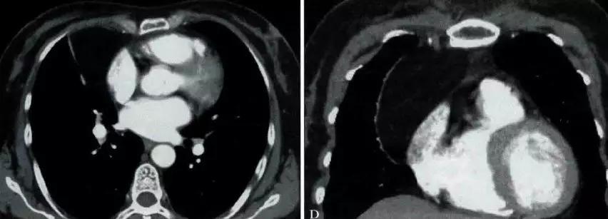 前上纵隔高密度影考虑胸腺未退化,肺纵隔胸腺结节12mm看什么科