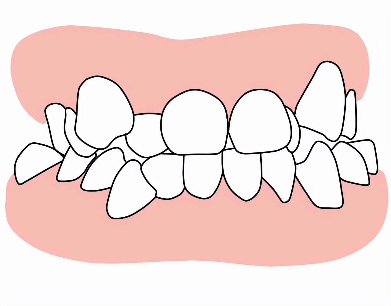 如何判断牙齿拥挤程度,牙齿拥挤对脸型的影响