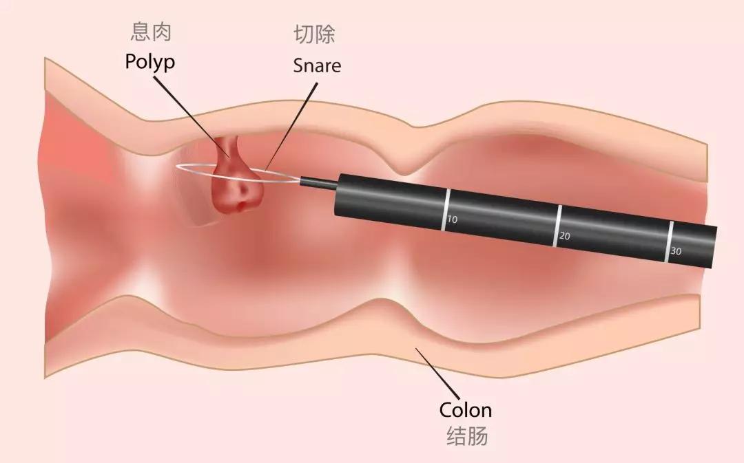 癌变的肉有哪些,身上长的肉赘会癌变吗