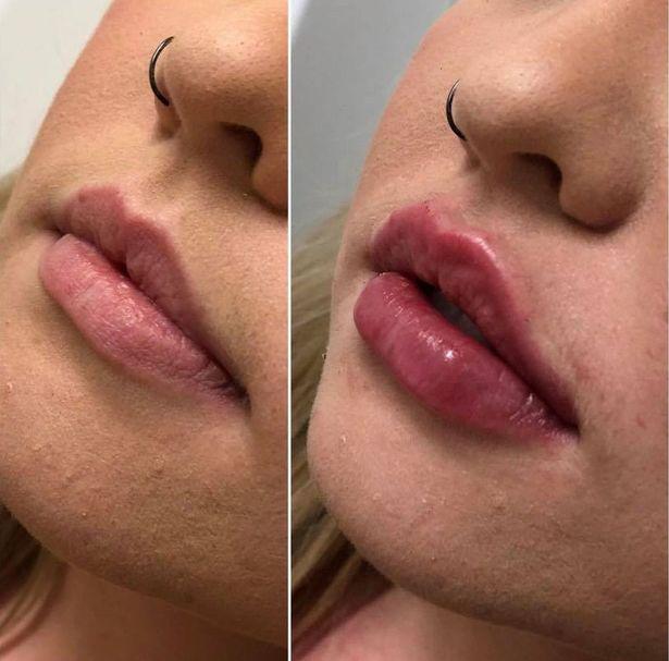 女子做丰唇手术超大嘴唇,做丰唇术嘴唇肿成香肠