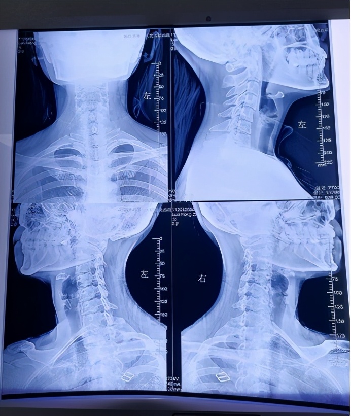 腰骶疼痛最佳治疗方法,腰坐骨神经疼了好多年怎么办