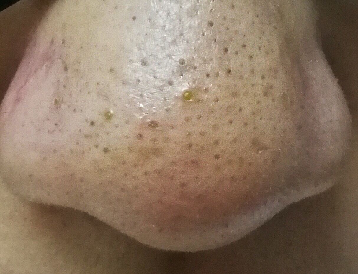 黑头如果不管它会一直在鼻子上吗,不管黑头行吗