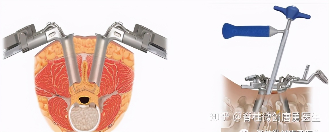 腰痛要警惕四种原因强直性脊柱炎,腰部脊柱结核是什么症状