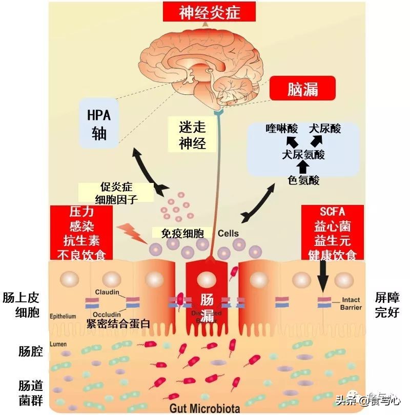 肠漏综合征的五大危害,肠瘘是一切病的根源