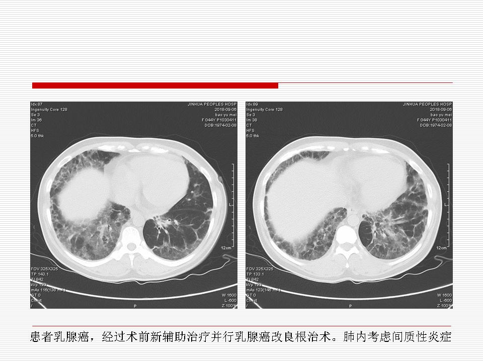 像炎症的肺癌能治好吗,医生说可能是肺癌也可能是炎症
