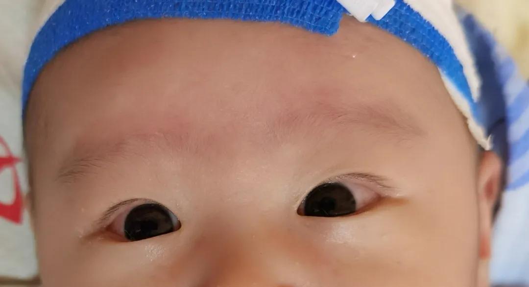 川崎病儿童临床表现,儿童川崎病复发指标