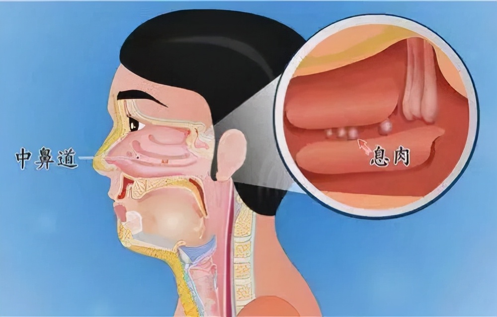 “鼻息肉”有癌变的风险！必须切除，而你却不知道