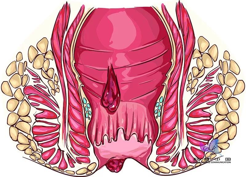 不敢相信！十人九痔竟与这一习惯有关！很多人每天都做却毫不知情