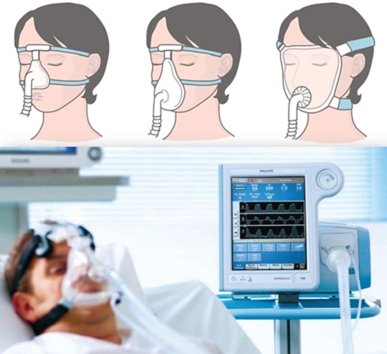 感染病毒,死于窒息:肺里究竟发生了什么?