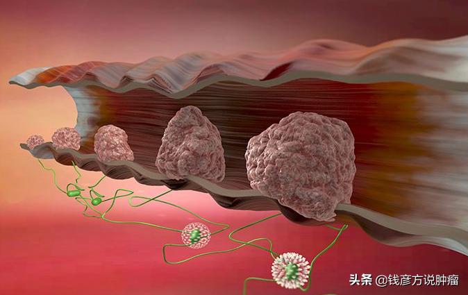 结节息肉肿瘤中医调理有妙方,中药消除肿瘤性结节