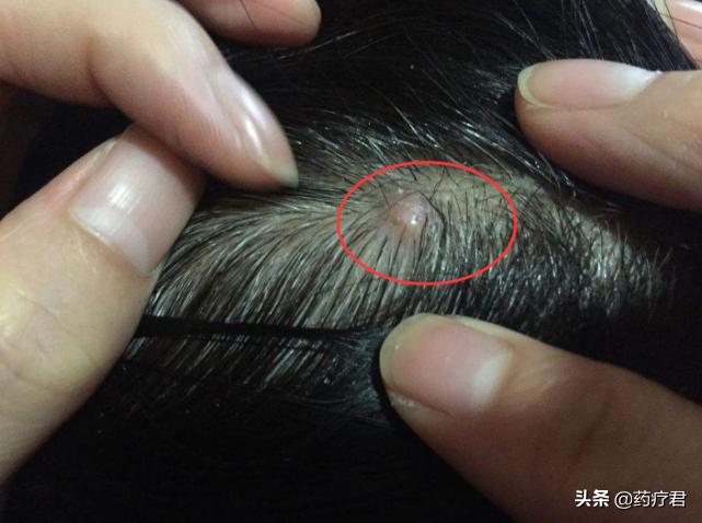 头皮痘痘一抠破就流很多血,头皮长痘痘摸上去痛怎么办