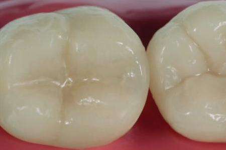 补牙树脂修复牙齿,大连市口腔医院牙齿修复