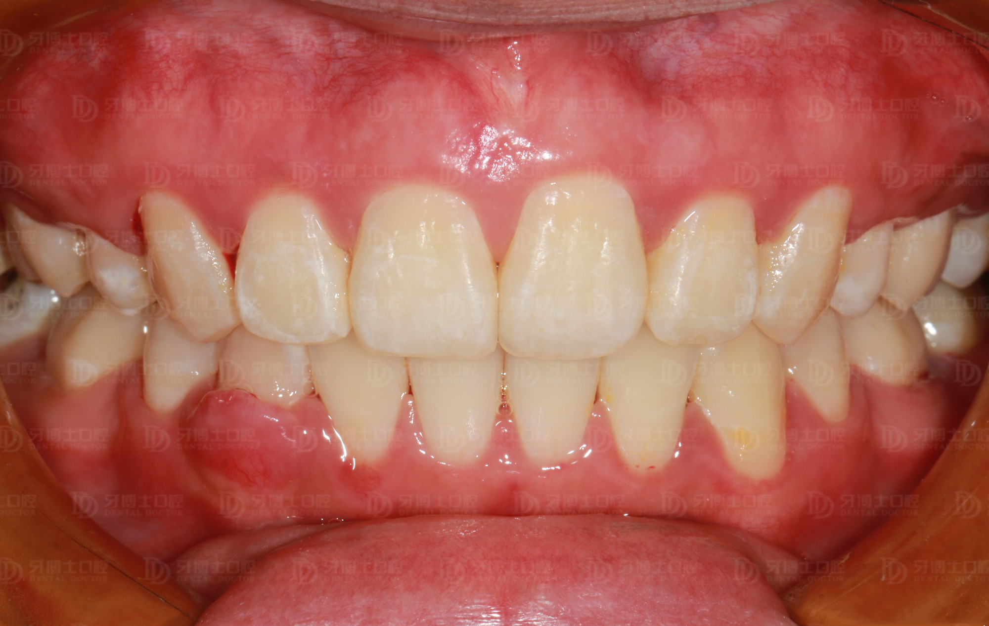 八岁孩子牙齿不齐用什么矫正,十岁小孩牙齿不齐需要矫正吗