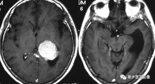 影像学脑室扩大,脑室显大怎么理解