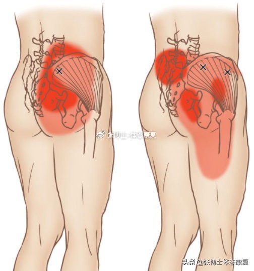 功能训练之核心稳定,功能训练练臀