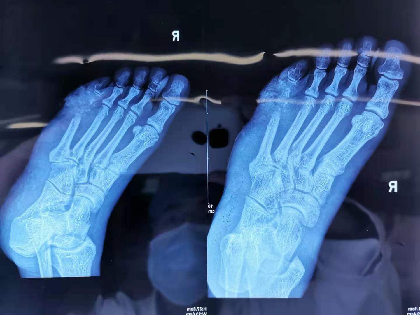 中西医结合治疗糖尿病,糖尿病足中西医结合指南