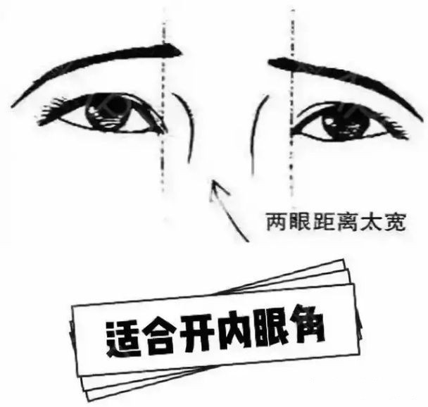 开眼角真的能变漂亮吗,关于开眼角你都了解什么