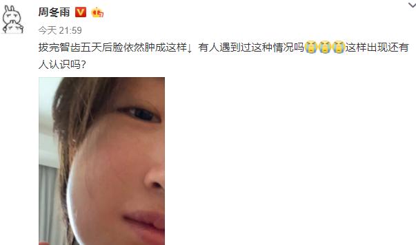 周冬雨拔智齿脸肿成了表情包,周冬雨拔智齿前后脸型对比图