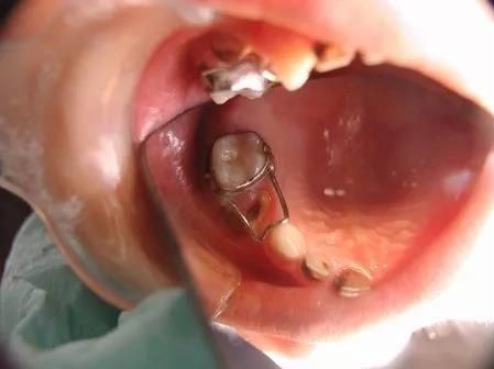 牙齿小洞不补下一句是什么,牙齿小洞不补大洞吃苦的意思