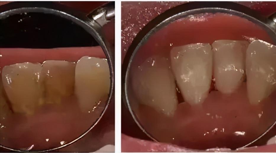 洗牙之后牙缝敏感,洗牙疼不疼